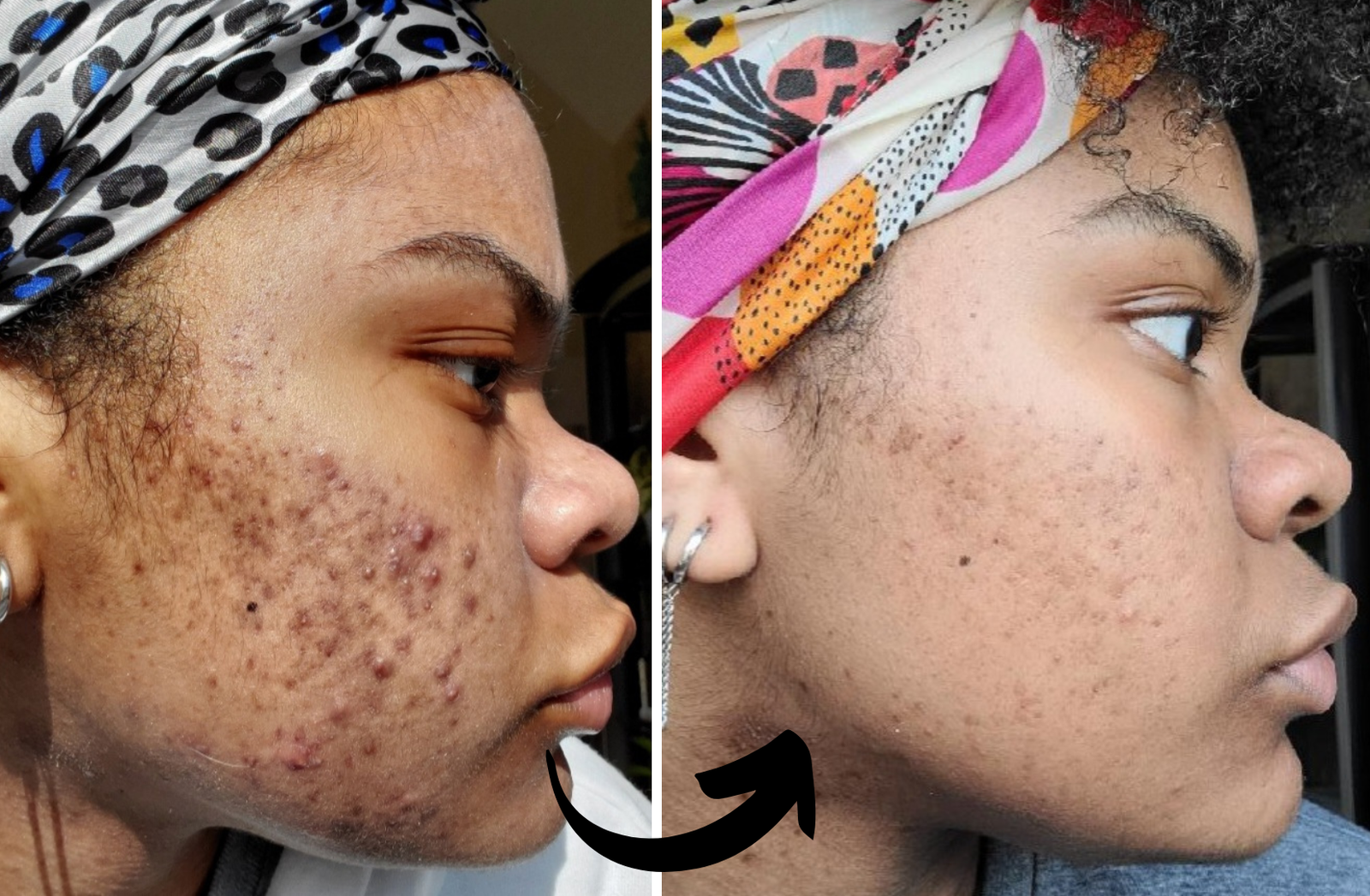 before and after- Xubian wellness and acne clinic client
