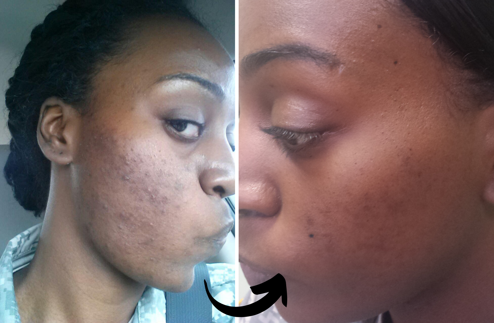 before and after photo of a black woman's skin cleared of acne - Xubian wellness and acne clinic client