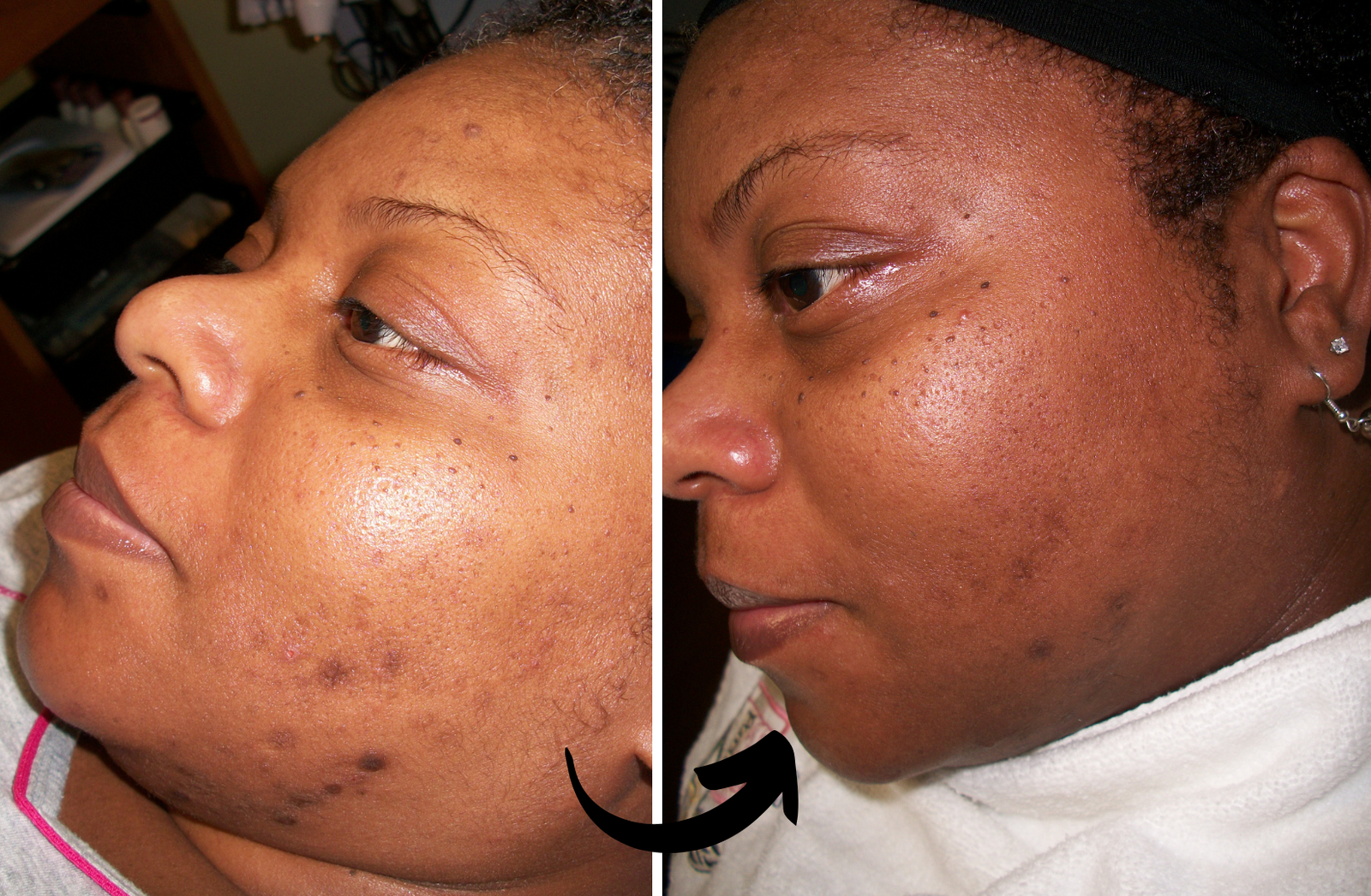 before and after dark spot treatment-- corrective skincare treatment solution Why Choose Xubian Acne Clinic? Read real life acne treatment and corrective skincare testimonials, reviews and client stories of Xubian Wellness & Acne Clinic