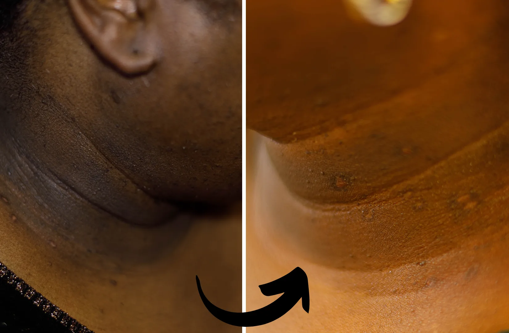 before and after photo of DPN removal at Xubian wellness and acne clinic - non-laser treatments- corrective skincare treatments