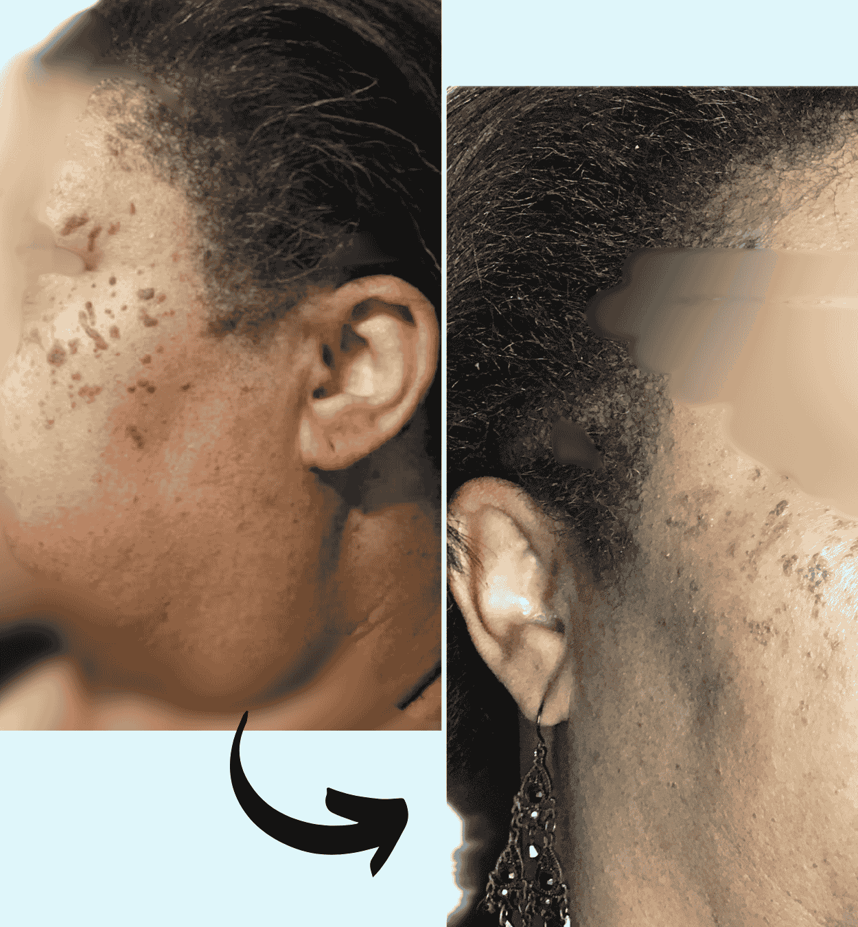 before and after photo of DPN removal at Xubian wellness and acne clinic - non-laser treatments- corrective skincare treatments