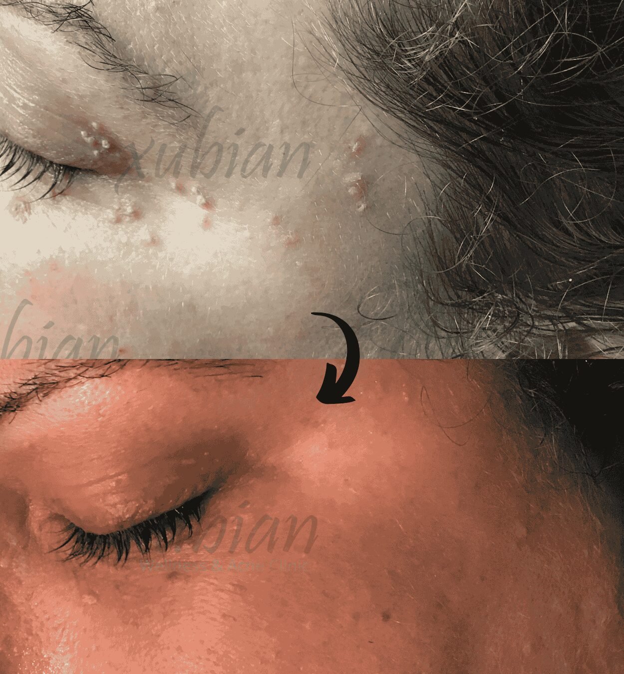 non-laser treatment for minor skin imperfections