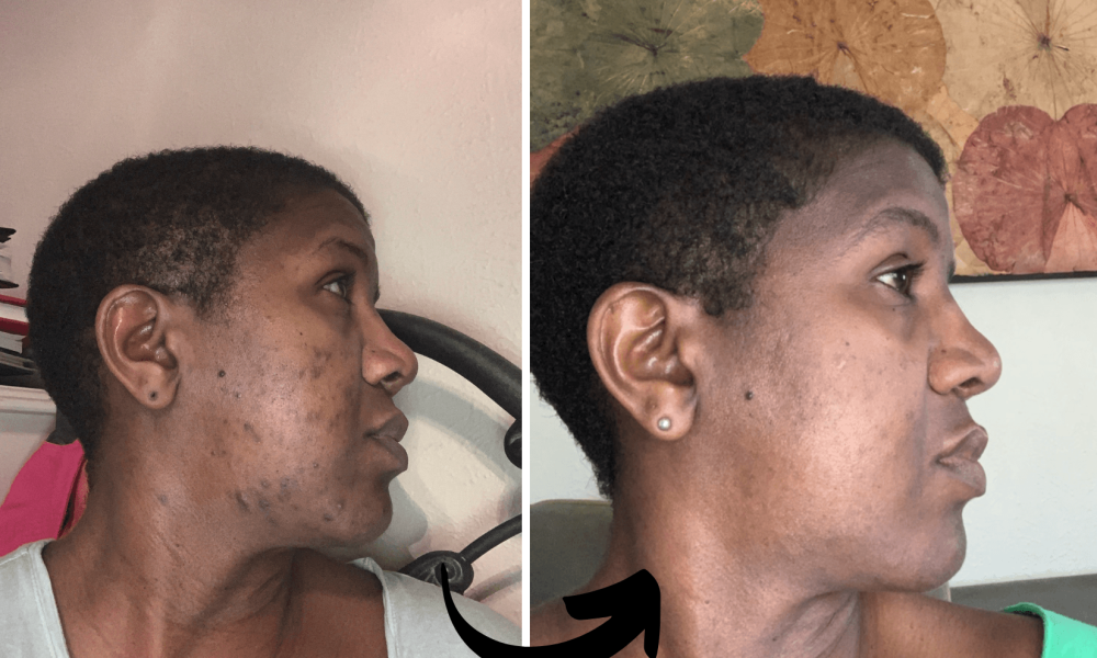 before and after- Xubian wellness and acne clinic client