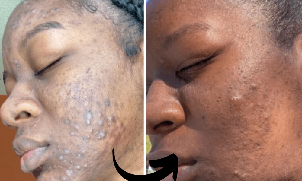 before and after- Xubian wellness and acne clinic client