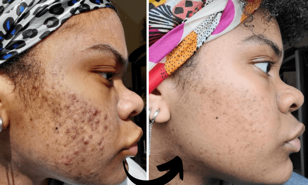 before and after- Xubian wellness and acne clinic client