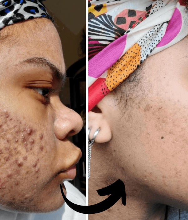 before and after- Xubian wellness and acne clinic client