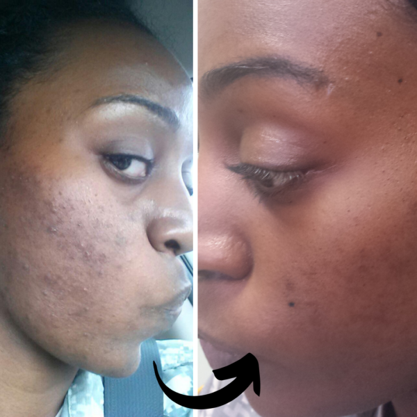 before and after photo of a black woman's skin cleared of acne - Xubian wellness and acne clinic client
