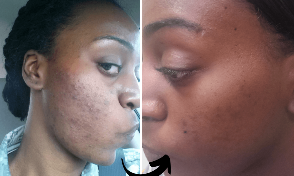 before and after photo of a black woman's skin cleared of acne - Xubian wellness and acne clinic client