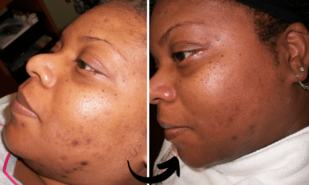 before and after dark spot treatment-- corrective skincare treatment solution Why Choose Xubian Acne Clinic? Read real life acne treatment and corrective skincare testimonials, reviews and client stories of Xubian Wellness & Acne Clinic