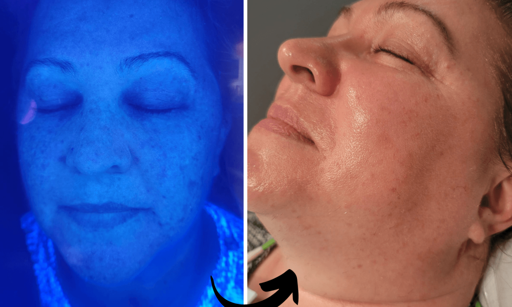 before and after- Xubian wellness and acne clinic photo review- wellness services