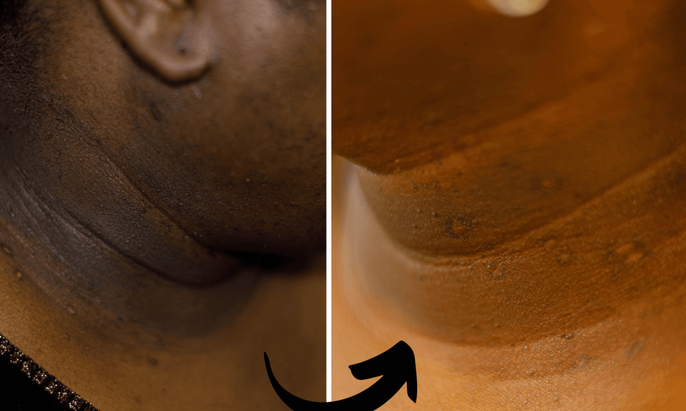 before and after photo of DPN removal at Xubian wellness and acne clinic - non-laser treatments- corrective skincare treatments