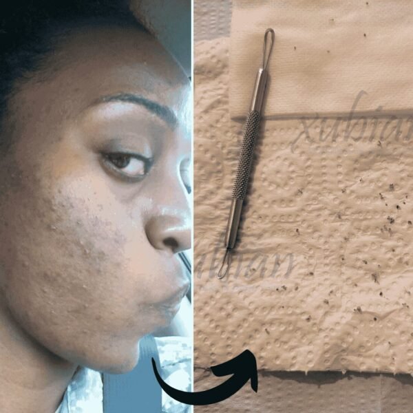 before and after photo of a black woman's skin cleared of acne - Xubian wellness and acne clinic client