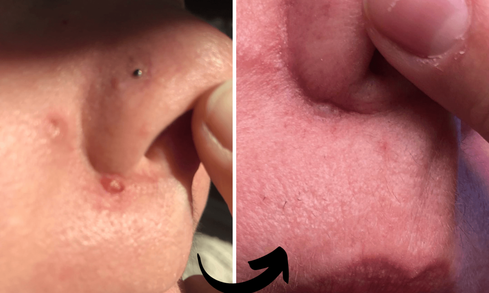 before and after- Xubian wellness and acne clinic client